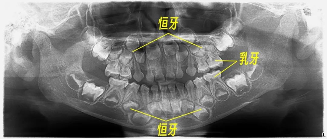 5岁孩子的口腔全景片（影像放射科  邓志强医师提供）