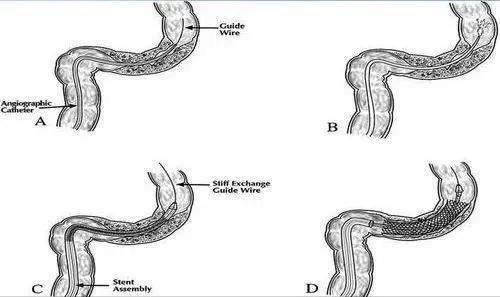 肠道支架的作用